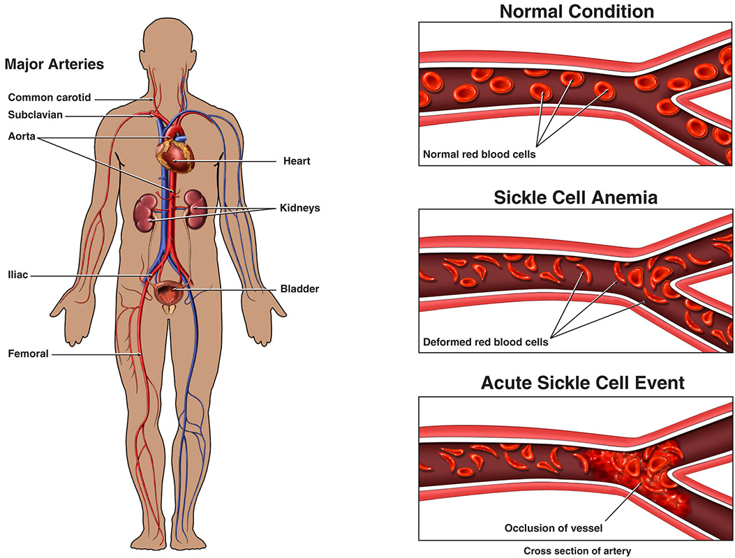 what-is-sickle-cell-disease-city-of-hope